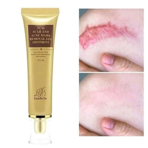 Acne Mark Removal, Acne Scar Cream, Acne Scar Removal Cream, Scar Remover, Scar Removal Cream, Scar Cream, Pimples On Face, Acne Gel, Learn Makeup