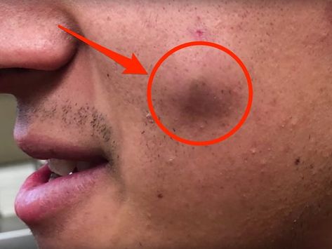 Dr. Pimple Popper Video Shows a Cheek Cyst Full of 'Oatmeal' Hard Pimple, Lip Pimple, Head Pimples, Huge Pimple, Ear Pimple, Back Pimples, Pimple Popper Videos Black Heads, Pimple Extraction, Pimple Popper Tool