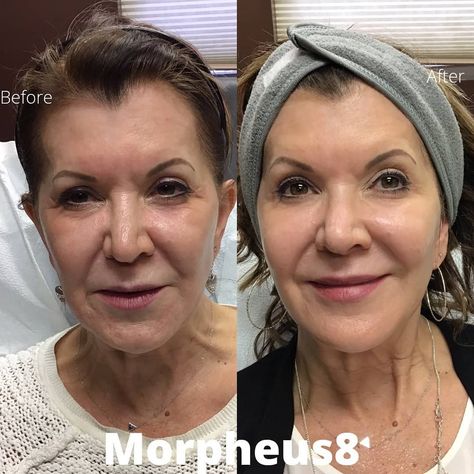 Morpheus8 Before And After, Morpheus 8 Before And After, Morpheus 8 Before And After Face, Face Morph Celebrity, Face Yoga Results Before And After, Faceapp Morphing Celebrities, Face Procedures, Juvederm Voluma, Breast Lift