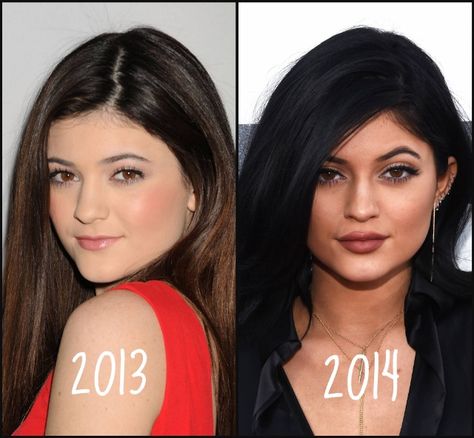 Kylie Jenner #KylieJenner #Beautiful #Celebrity #Stunning #FacePic #BeforeAndAfter Wide Lips, Kylie Jenner Plastic Surgery, Botox Brow Lift, Jenner Girls, Kylie Jenner Pictures, Kylie Jenner Lips, Jenner Makeup, Facial Fillers, Diy Beauty Treatments