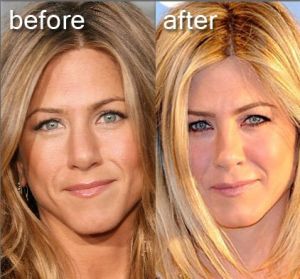 Jennifer gets the non-surgical nose job! Jennifer Aniston Nose Job, Jennifer Aniston Nose, Jennifer Aniston Hair, Jennifer Aniston Style, Fat Burning Diet, Celebrity Plastic Surgery, Breast Lift, Nose Job, Jennifer Connelly