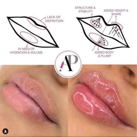 Lip Fillers Juvederm, Dermal Fillers Lips, Pdo Threads, Lips Inspiration, Botox Lips, Aesthetic Dermatology, Audrey Rose, Botox Cosmetic, Facial Fillers