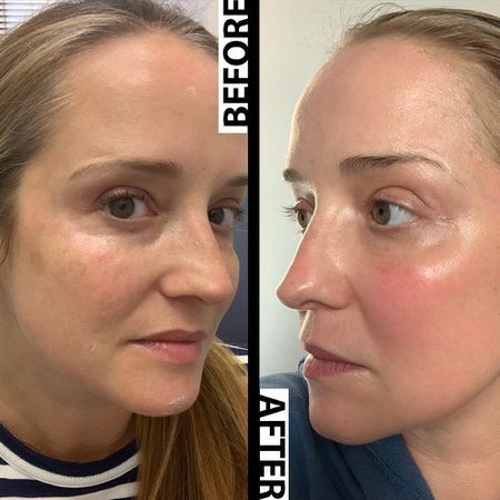 Before And After Some Image Fraxel Laser Before And After, Fraxel Laser, Face Laser, Skincare Wishlist, Skin Peel, Remove Skin Tags Naturally, Laser Skin Resurfacing, Fractional Laser, Laser Resurfacing