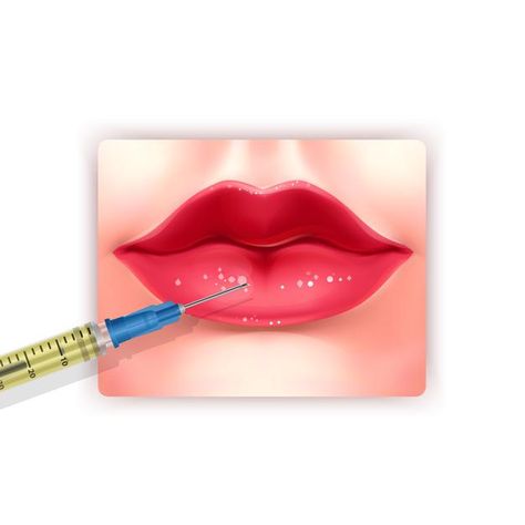 Lips injection. lip augmentation injecta... | Premium Vector #Freepik #vector #girl #lips #injection #collagen Lip Gel Injection, Lips Injection, Cosmetic Fillers, Girl Lips, Lip Gel, Vector Girl, Lip Augmentation, Art 2023, Lip Injections