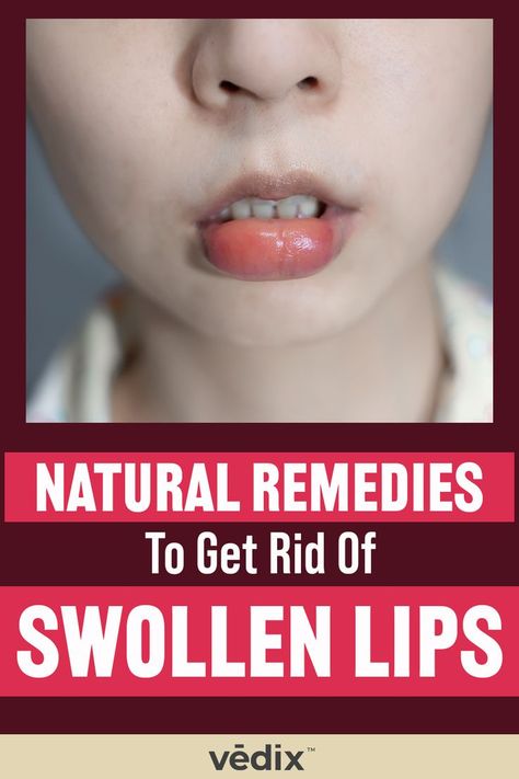 Lip Swelling Swollen Lip Remedy, Swelling Remedies, Swollen Lips, Ayurveda, Natural Remedies, Allergies, How To Find Out, Lips, Skin Care