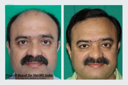 What is the cost of FUE hair transplant in India? Hair Transplant Cost, Hair Transplant Results, Fue Hair Transplant, Cheap Hair Products, Lip Fillers, Hair Transplant, Autoimmune Disease, Hair Follicle, Pune