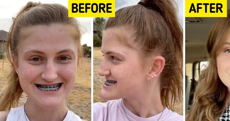 In a world where people are all about finding themselves and facing challenges, a young woman bravely shares her experience of getting double jaw surgery. She takes everyone along on her journey, showing the ups and downs of the process. As she reveals the before-and-after pictures, people can’t help but be amazed at the incredible results. Celebrity Before And After Surgery, Double Jaw Surgery Before And After, Jaw Surgery Before And After, Double Jaw Surgery, Plastic Surgery Gone Wrong, Jaw Surgery, Pictures People, Liquid Diet, Celebrities Before And After