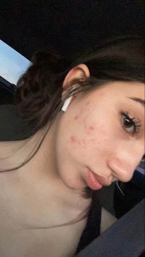 People With Acne Pretty, Beautiful Girls With Acne, Acne Normalization, Back Acne Aesthetic, Natural Makeup Acne, Acne Skin Aesthetic, Acne Aesthetic Girl, Bad Acne Pictures, Acne Girls Pretty