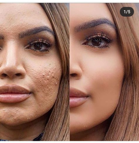 Acne Free Skin, Makeup News, Celebrity Plastic Surgery, Cystic Acne, Instagram Tags, Makeup Geek, Nyx Cosmetics, Insta Makeup, Makeup Collection