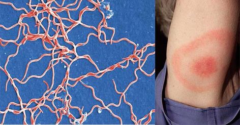 What is Borrelia burgdorferi? Borrelia burgdorferi is the causative agent of Lyme disease, mostly occurring in North America and Europe. It is a member of the eubacterial phylum Spirochaetes named after their spiral or wave-like body and flagella. B. burgdorferi ... Read more The post Borrelia burgdorferi (Lyme Disease)- An Overview appeared first on Microbe Notes. Tick Bite, Gene Expression, Cell Wall, Immune Response, Microbiology, Disease, North America, Medical, Google Search