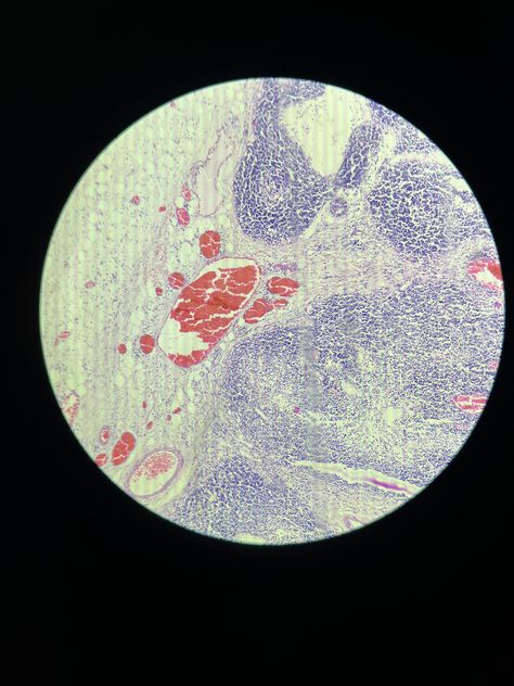 Caseous Necrosis Lymph node Lymph Node, Lymph Nodes, Slides