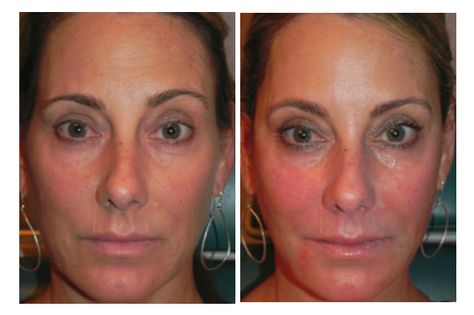 Sculptra Before and After Sculptra Before And After Faces, Sculptra Before And After, Facial Fat Loss, Sculptra Aesthetic, Suture Material, Mini Face Lift, Face Contouring Makeup, Face Change, Operating Room