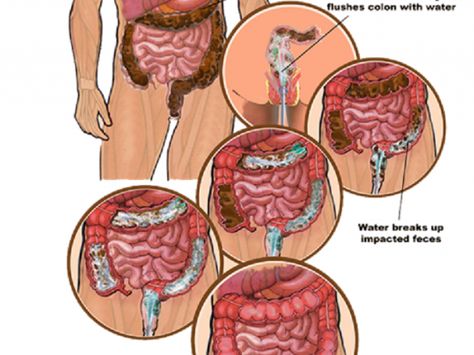 Colin Cleanse, Colon Cleanse Benefits, Herbal Colon Cleanse, Colon Therapy, Homemade Colon Cleanse, Colon Cleanse Diet, Healthy Colon, Clean Colon, Cleaning Your Colon