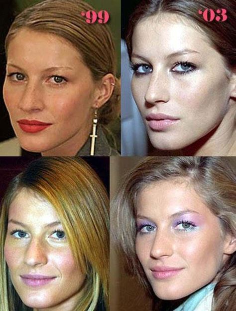 Celebrity Nose Jobs: Before and After Nose Ideas, Nose Jobs, Hair Implants, Celebrity Plastic Surgery, Cool Skin Tone, Celebrities Before And After, Gisele Bündchen, Nose Job, Makeup Transformation