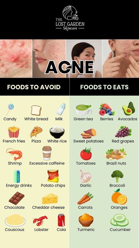 Food For Acne, Foods For Clear Skin, Clear Skin Diet, Acne Diet, Skin Diet, Acne Free Skin, Food To Eat, Clear Healthy Skin, Natural Acne