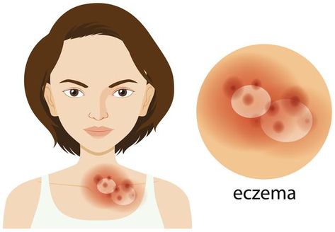 Woman and eczema problem | Free Vector #Freepik #freevector #background #people #education #medical Scaly Skin, Skin Dryness, Skin Redness, Skin Disorders, Hemp Seed, Skin Diseases, Oil Benefits, Best Essential Oils, Hemp Seed Oil