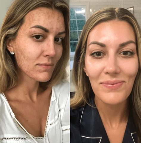 Skin Resurfacing At Home, Diy Microneedling At Home, Microchanneling Before And After, Before And After Microneedling, Prp Microneedling Before And After, Dr Pen Microneedling Before And After, Moxi Laser Before And After, Microdermabrasion Before And After, Rf Microneedling Before And After