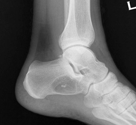 Calcaneal lipoma with Cockade sign | Radiology Case | Radiopaedia.org Brutal Obsession, Manual Muscle Testing, Ankle Fracture, Muscle Testing, The Badge, Gold Ring Designs, Mehendi Designs, Radiology, X Ray