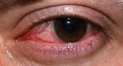 Dry Eye Symptoms, Bloodshot Eyes, Swollen Eyes, Irritated Eye, Eye Infections, Sore Eyes, Healthy Eyes, Eyes Problems, Liver Health