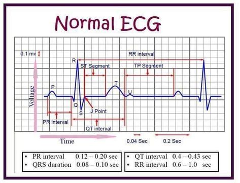 Normal Ecg, Nursing School Studying Cheat Sheets, Emt Study, Nursing Labs, Cardiology Nursing, Medical Assistant Student, Nursing School Essential, Nclex Study, Medicine Notes