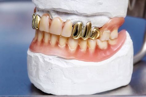 Types of Dental Gold Permanent Gold Teeth, Types Of Crowns, Porcelain Crowns, Tooth Crown, Tooth Cavity, Tooth Filling, Dental Restoration, Partial Dentures, Dental Fillings