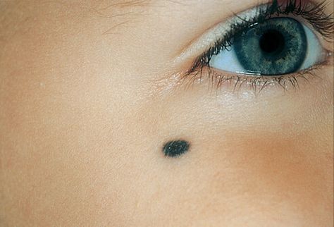 nevus- known as birthmark. malformation of the skin from abnormal pigmentation or dilated capillaries Skin Marks, Skin Center, Skin Moles, Skin Disorders, Skin Diseases, Pictures Images, Dermatology, Image Collection, Slot Gacor