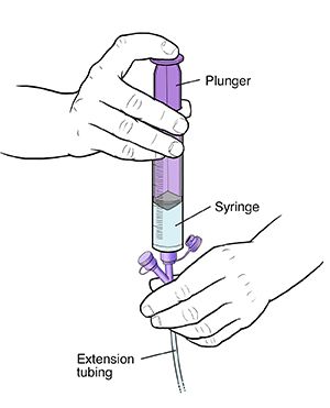 Your Child's Nasogastric Tube: Flushing the Tube | Saint Luke's Health System Nasogastric Tube Nursing, Nasogastric Tube, Home Health Nurse, Numbers To Call, Saint Luke, Hospital Staff, Feeding Tube, The Tube, Health System