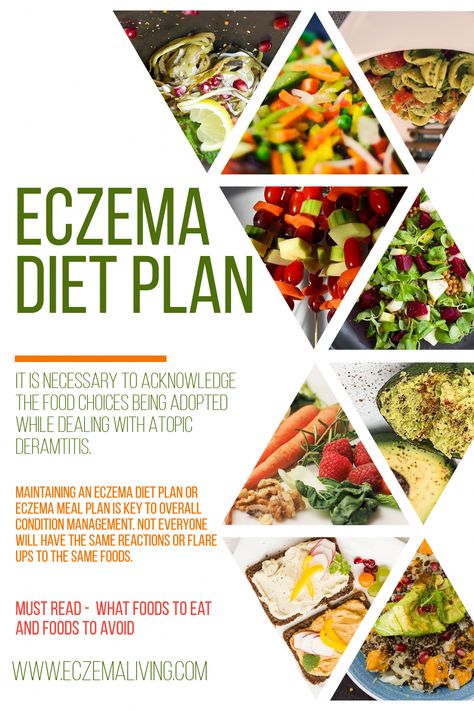 It is necessary to acknowledge the food choices being adopted while dealing with Atopic Deramtitis. One may not take into consideration but consumption of specific foods may result in eczema flare ups. This post includes a detail about the Foods for eczema, Eczema Elimination Diet plan, Seasonal Diet for Eczema-Care and much more. #TheBestDietPlanToLoseWeightFast Elimination Diet Plan, Moisturizers For Dry Skin, Daily Diet Plan, Best Healthy Diet, Best Diet Foods, Healthy Eating Diets, Low Fat Diet, Low Carb Diet Plan, Low Salt