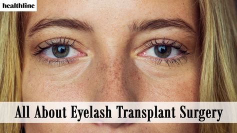 What is eyelash transplant surgery? “Eyelash transplant surgery involves moving hair from one part of the body (usually the back of the head) to the eyelash area (upper or lower eyelid),” explained board-certified plastic surgeon Gary Linkov, MD. “This helps guarantee a fuller and longer lash appearance,” he said. Read More Eyelash Implants, Facial Plastic, Back Of The Head, Long Lashes, Plastic Surgeon, Surgery, Eyelashes, Lashes, Facial