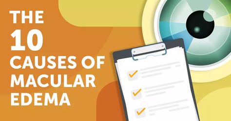 The 10 Causes of Macular Edema | DiabetesTeam Eye Damage, Laser Surgery, Vision Loss, Vision Problems, Eye Surgery, Early Intervention, High Blood Sugar, Growth Factor, Laser Therapy