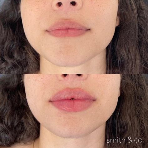 Lip Filler Technique, Lip Lift, Lips Inspiration, Danielle Smith, Botox Lips, Facial Fillers, Facial Contouring, Small Lips, Facial Aesthetics