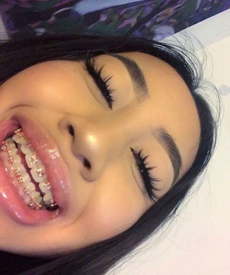 Invisible Teeth Braces, Natural Teeth Whitening Diy, Cute Braces Colors, Braces Tips, Getting Braces, Maquillage On Fleek, Braces Girls, Invisible Braces