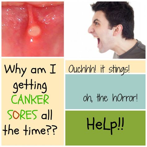 Canker sores are painful and annoying. By knowing the possible causes of canker sores, we can learn to prevent canker sores from appearing again. Highly acid foods can burn the soft skin in our mouth Blister In Mouth, Canker Sore Causes, Mouth Blisters, Canker Sore Remedy, Natural Remedies For Migraines, Canker Sore, Dry Skin Remedies, Cold Sores Remedies, Cold Home Remedies