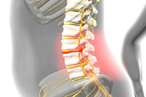 Do I Have a Herniated Disk? Herniated Disk In Lower Back, Bulging Disc, Disk Herniation, Nerve Damage, Spinal Cord, Aids Hiv, Muscle Pain, Aging Well, Back Pain