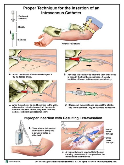 50 Intravenous Therapy (IV) Tips and Tricks For Nurses Nursing Iv, Nursing Information, Intravenous Therapy, Nursing School Survival, Nursing Schools, Nursing School Studying, Nursing School Tips, Nursing School Notes, Iv Therapy