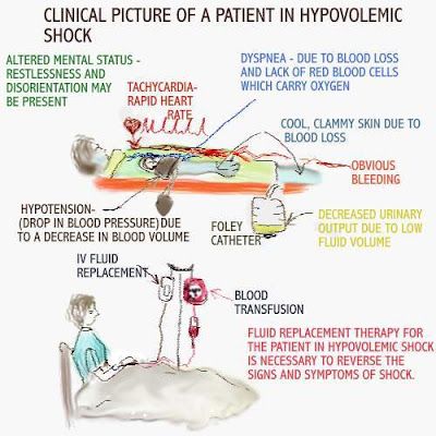 I have hypovolemia and have gone into hypovolemic shock MANY times. It is related to my dysautonomia, NOT from blood loss due to an injury. Hypovolemic Shock Nursing, Hypovolemic Shock, Memes Nursing, Nursing Information, Nursing Board, Med Surg Nursing, Nursing Humor, School Nursing, Nursing Mnemonics