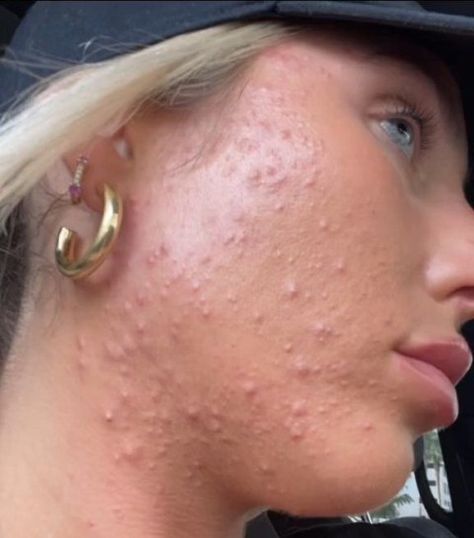 Woman who cried three times a day due to acne shares skin journey Skin Before After, Doxycycline For Acne Before And After, Acne Before And After, Tretinoin Before And After Acne, Acne Is Beautiful, Acne Triggers, Acne Girl, Beautiful Acne, Accutane Before And After