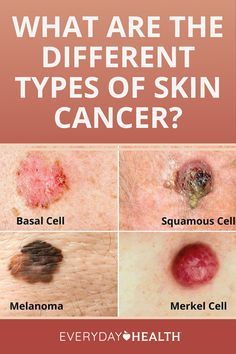 Basal Cell, Skin Moles, Squamous Cell, Types Of Skin, How To Remove Pimples, Health Planner, Breast Health, Skin Disorders, Types Of Cancers