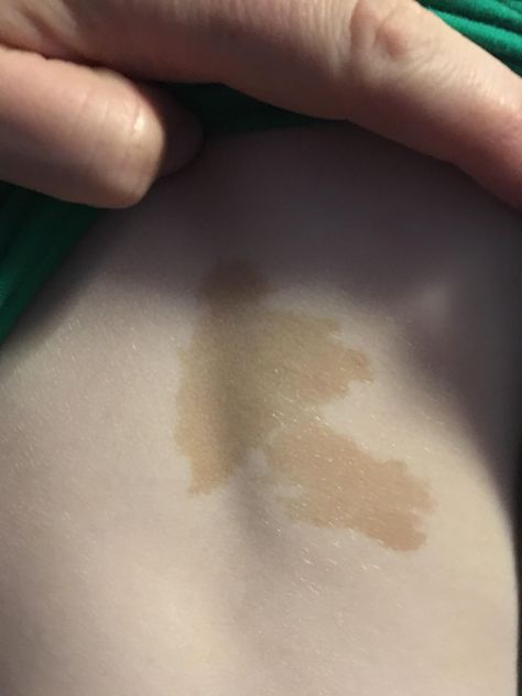 My son has a beautiful mushroom shaped birthmark on his back Beauty Marks Aesthetic, Birthmarks Aesthetic, Beauty Marks, Beauty Mark, Instagram Ideas Post, Instagram Ideas, Character Designs, My Son, When He