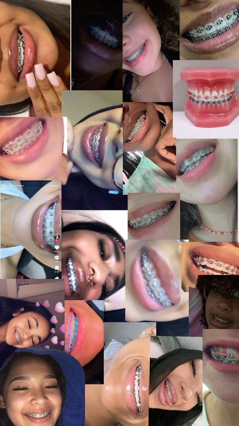 Teal Braces On Black People, Brace Tips, Dark Blue Braces, Brace Ideas, Black Braces, Cute Braces Colors, Pretty Teeth, Braces Tips, Getting Braces