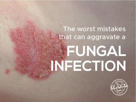 Fungal infection is an infectious skin condition  leading to irritation, scaly skin, redness, itching, swelling, and blisters. It can take place anywhere on the body. Once fungal infection is acquired, it takes quite some time to get rid of it.    Read the blog and find out the worst mistakes that can aggravate a fungal infection Staphylococci Bacteria Infection On Skin, Skin Rash Remedies, Fungal Rash, Fungal Infection Remedies, Rashes Remedies, Skin Fungus, Fungal Infection Skin, Sick Remedies, Scaly Skin