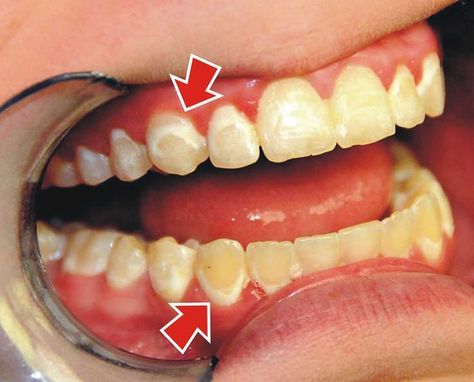 White Spots After Braces if teeth are not brushed properly and plaque is left around the bracket Teeth After Braces, After Braces, Plaque Teeth, Braces Tips, Braces Off, Discolored Teeth, Teeth Whitening Toothpaste, Braces Colors, Charcoal Teeth Whitening