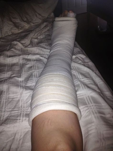 Leg Fracture Snapchat, Broke Leg Snapchat, Fracture Photo, Clear Glasses Frames Women, Whale Tail Thong, Hospital Photography, Hospital Pictures, Girls Dorm Room, Tumblr Pics