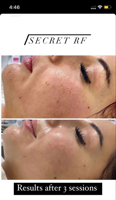 Dermapen Microneedling, Facial Massage Techniques, Bad Eyebrows, Skin Care Pictures, Facial Cupping, Laser Resurfacing, Facial Fillers, Skin Advice, Skin Aesthetics