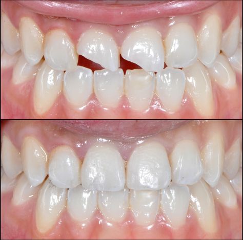 Anterior Composite Restoration Teeth Makeover, Dentist Quotes, Dental Makeover, Dental Ceramics, Sensitive Teeth Remedy, Veneers Teeth, Beautiful Teeth, Laser Teeth Whitening, Porcelain Veneers