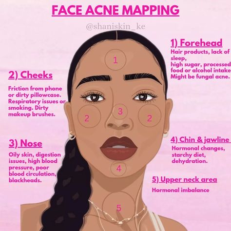 Face Breakout Chart, Acne Mapping Face, Acne On Face Meaning, Things That Help With Acne, Break Out Zones Face, Skin Problems Face, Acne On Forehead, Acne Map, Girly Skincare