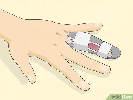 How to Determine if a Finger Is Broken: Symptoms & More Diy Finger Splint, Broken Finger Splint, Medical Stitches, Fractured Finger, Jammed Finger, Broken Thumb, Crooked Fingers, Flex Seed, Hairline Fracture