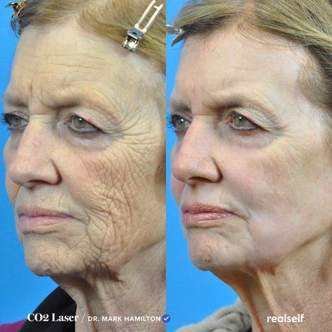 Laser Skin Rejuvenation, Laser Skin Tightening, Laser Facial, Laser Skin Resurfacing, Skin Tightening Treatments, Fractional Laser, Laser Resurfacing, Makeup Tips For Older Women, Cosmetic Dermatology