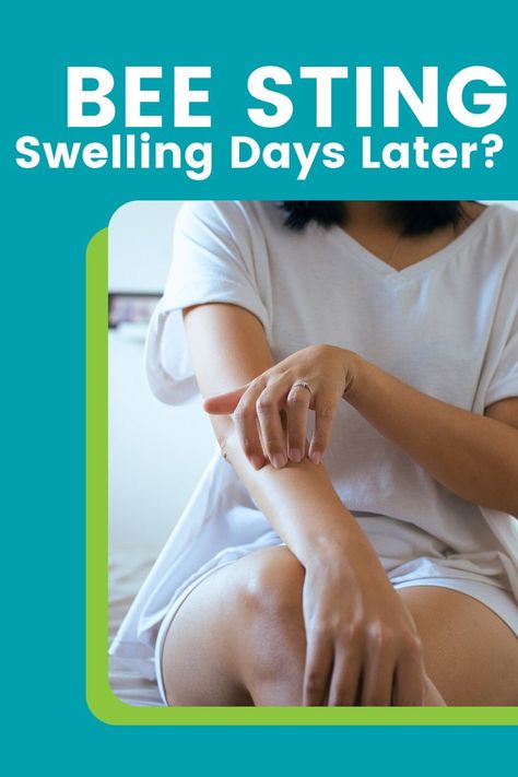 If you experience a bee sting swelling days later, you aren’t alone. Discover why this can happen and what symptoms to watch for. Bee Sting Swelling, Bee Sting, Allergy Symptoms, What To Use, Allergies, Bee