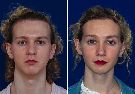 Facial Feminization Surgery Before & After | FACIALTEAM How To Feminize Your Face, Facial Fem Surgery, Ffs Surgery Before And After, Ffs Surgery, Before And After Contouring, Facial Reconstruction Surgery, Jaw Reduction Surgery, V Line Surgery, Face Contouring Makeup